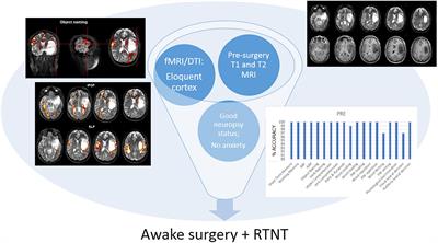 Real-Time Neuropsychological Testing Protocol for Left Temporal Brain Tumor Surgery: A Technical Note and Case Report
